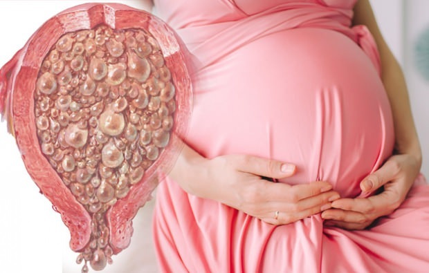 Τι είναι η εγκυμοσύνη σταφυλιών, τα συμπτώματα εγκυμοσύνης σταφυλιών