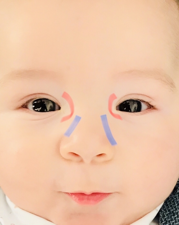 Μασάζ στο μάτι σε μωρά