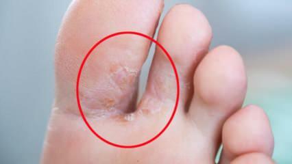 Τι είναι ο μύκητας των ποδιών; Ποια είναι τα συμπτώματα του μύκητα των ποδιών; Υπάρχει μια θεραπεία για το πόδι του αθλητή;