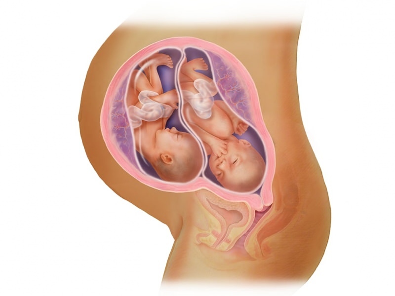 Δίδυμη εγκυμοσύνη σε εξωσωματική γονιμοποίηση! Τι είναι η μεταφορά εμβρύων;