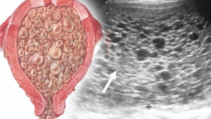 Τι είναι εγκυμοσύνη μοσχεύματος (εγκυμοσύνη σταφυλιών), ποια είναι τα συμπτώματα; Πώς να κατανοήσουμε την εγκυμοσύνη του mole;