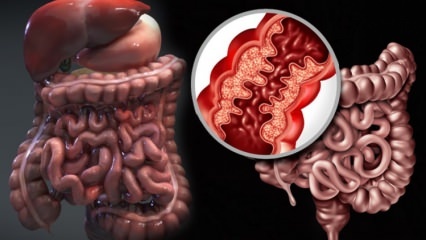 Τι είναι η νόσος του Crohn; Ποια είναι τα συμπτώματα της νόσου του Crohn; Υπάρχει μια θεραπεία για τον Crohn;