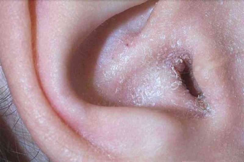 Τι προκαλεί το ξεφλούδισμα πίσω από το αυτί και πώς περνά; Η οριστική λύση για έκζεμα πίσω από το αυτί ...