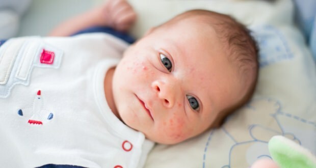 Πώς περνά η ακμή στο πρόσωπο του μωρού; Μέθοδοι ξήρανσης ακμής (Μηλιά)