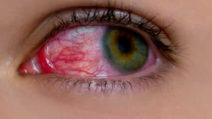 Τι προκαλεί την αλλεργία στα μάτια; Ποια είναι τα συμπτώματα της αλλεργίας στα μάτια; Τι είναι καλό για τις αλλεργίες στα μάτια; 
