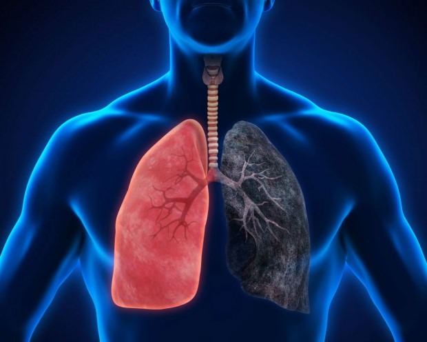 τι είναι καρκίνος του πνεύμονα