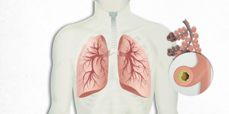 ο ιός που εγκαθίσταται στους πνεύμονες αναμιγνύεται με πνευμονία