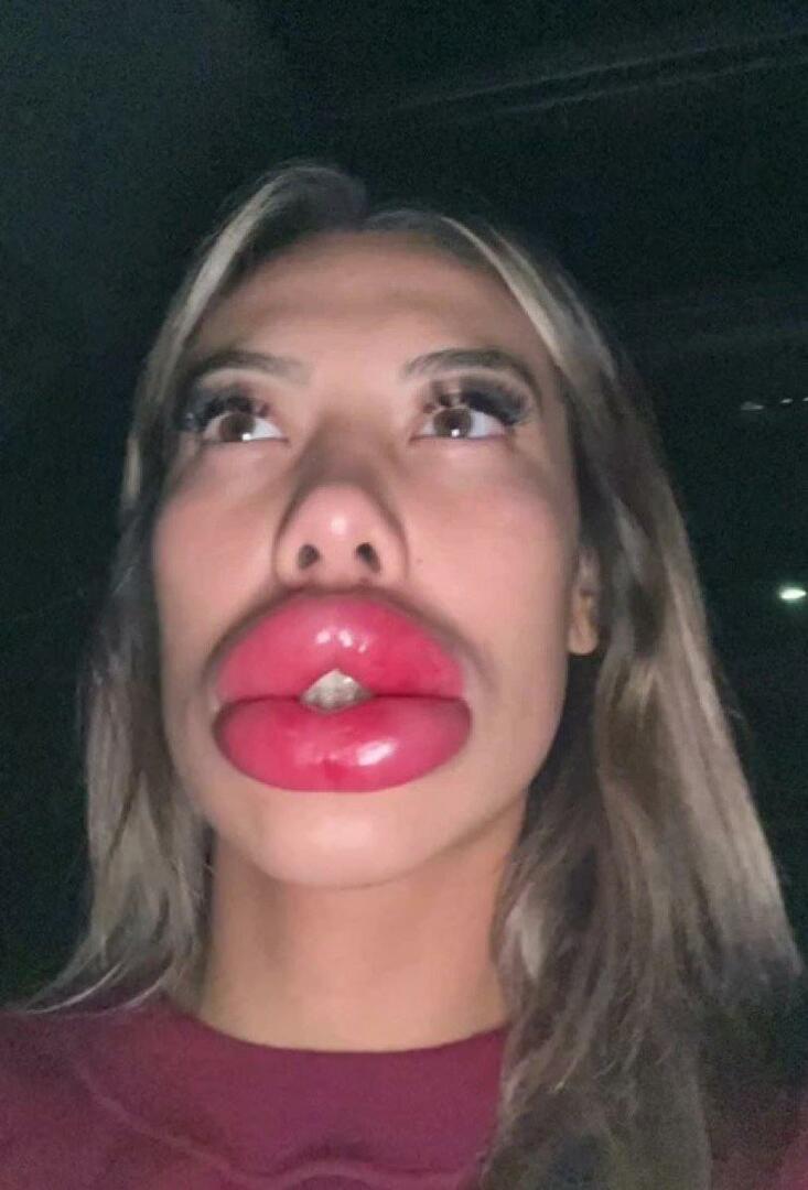 Μπήκε σε μπελάδες με το lip filler που είχε κάνει