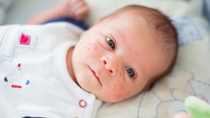 Πώς είναι τα σπυράκια στο πρόσωπο του μωρού; Μέθοδοι ξήρανσης ακμής (Μηλιά)