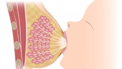 Τι είναι η μαστίτιδα (φλεγμονή του μαστού); Συμπτώματα μαστίτιδας και θεραπεία κατά τη διάρκεια του θηλασμού