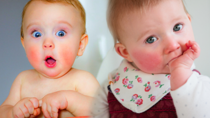 Προσοχή στα μωρά με κόκκινα μάγουλα! Το σύνδρομο του μάγουλο και τα συμπτώματα του