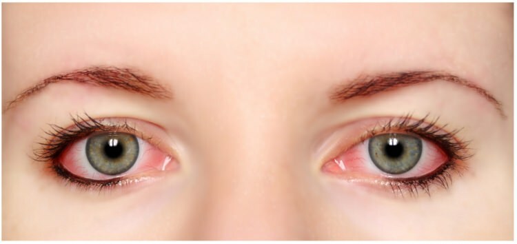 Η μάσκαρα και η αλλεργία στα μάτια στα μάτια;