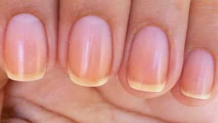 Γιατί κιτρινίζουν τα νύχια; Η πιο εύκολη μέθοδος για να λευκάνετε τα κιτρινισμένα νύχια από το βερνίκι νυχιών
