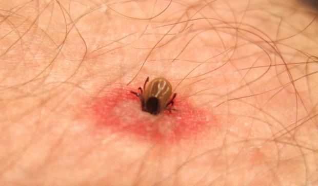 Τι τσιμπήματα εντόμων είναι πώς; Συμπτώματα δαγκωμάτων εντόμων! Φυσική μέθοδος για τσιμπήματα κουνουπιών