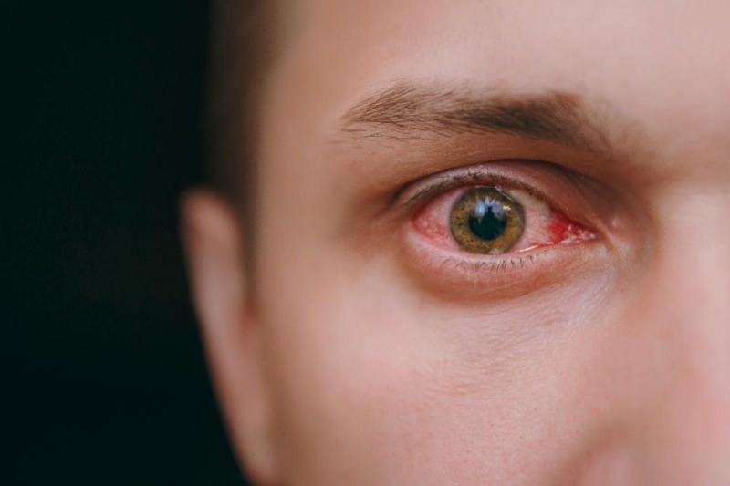 πότισμα στα μάτια, αιμορραγία και συμπτώματα κοροναϊού κνησμού