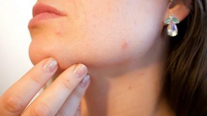 Τι είναι ο καρκίνος του δέρματος (μελάνωμα); Ποια είναι τα συμπτώματα του μελανώματος και υπάρχει θεραπεία;