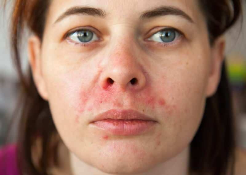 Γιατί εμφανίζεται η ακμή γύρω από το χείλος; Πώς θεραπεύεται η Perioral Dermatitis;
