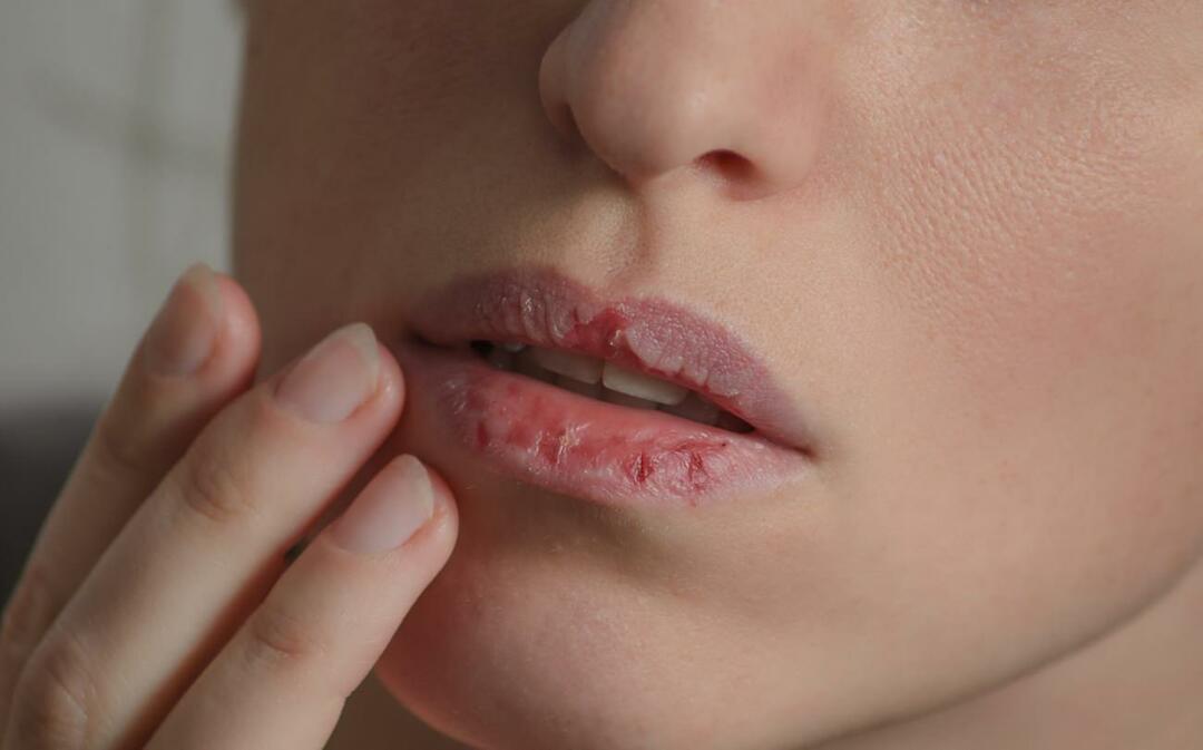 Τι προκαλεί τα σκούρα χείλη; Πώς αντιμετωπίζεται το σκουρόχρωμο ή οι μώλωπες των χειλιών;