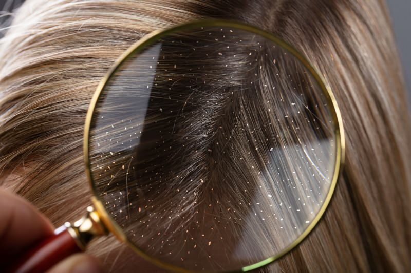 Πώς περνά η πιτυρίδα και τι είναι καλό για τα μαλλιά πιτυρίδας; Οι 5 πιο γρήγορες και πιο αποτελεσματικές θεραπείες πιτυρίδας