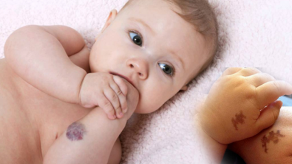 Προκαλεί σημάδι στα μωρά, είναι μόνιμο; Ποιοι είναι οι τύποι σημείων αναφοράς; Θεραπεία από τον Saracoglu