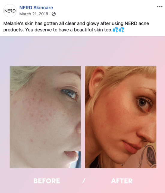 Παράδειγμα του τρόπου με τον οποίο η Nerd Skincare χρησιμοποίησε μια φωτογραφία πριν και μετά για να δημιουργήσει μια ανάρτηση εικόνας για κοινωνικά μέσα που οδηγεί τις αγορές των προϊόντων τους.