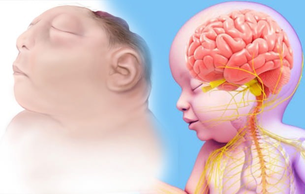 Το ζωντανό μωρό Anencephaly; Διάγνωση αναισθησίας