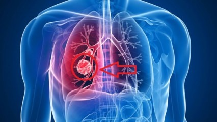 Τα συμπτώματα του καρκίνου του πνεύμονα: στάδια του καρκίνου του πνεύμονα!