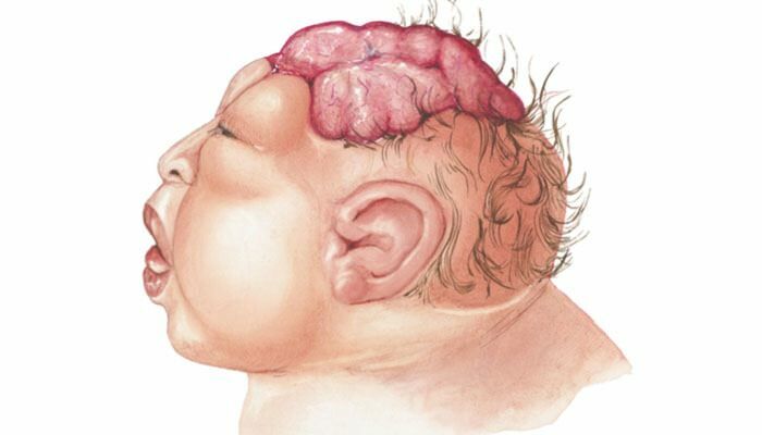 Τι είναι Anencephaly; Ποια είναι τα συμπτώματα της Ανεγκεφαλίας σε βρέφη και παιδιά; Η αιτία της αναισθησίας ...