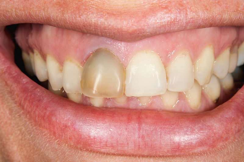 τα δόντια που σκουραίνουν μπορεί μερικές φορές να επικεντρωθούν σε ένα δόντι