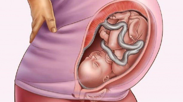 Τι είναι το placenta previa;