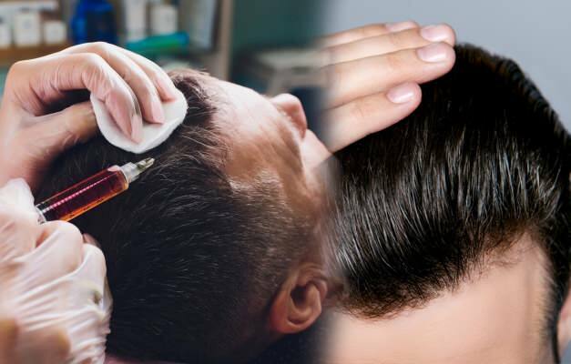 Επιτρέπεται η μεταμόσχευση μαλλιών; Τι είναι τα προσθετικά μαλλιά;