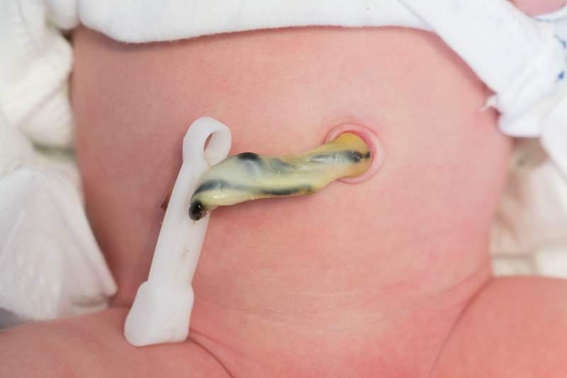 Πότε κόβεται ο ομφάλιος λώρος στα μωρά; Οφέλη από την αργή κοπή του ομφάλιου λώρου