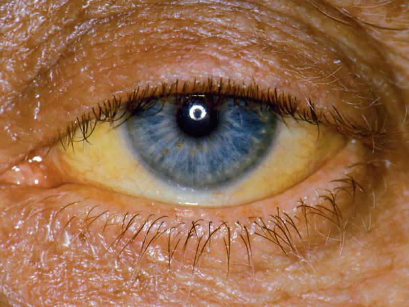 Το ύψος στο επίπεδο της χολερυθρίνης προκαλεί κίτρινο χρώμα στα μάτια και το δέρμα