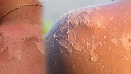 Τι είναι καλό για την απολέπιση του δέρματος και πώς είναι το ξεφλούδισμα του δέρματος; Οικιακή θεραπεία για απολέπιση του δέρματος