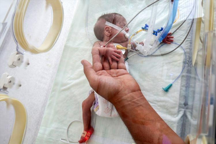 Το «θαύμα μωρό» κατάφερε να επιβιώσει από τη χειρουργική επέμβαση