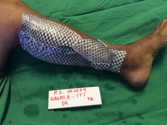 Το δέρμα των ψαριών έχει περάσει στο ιατρικό ιστορικό στη θεραπεία των εγκαυμάτων