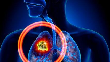 Ποια είναι τα συμπτώματα του καρκίνου του πνεύμονα; Υπάρχει θεραπεία για τον καρκίνο του πνεύμονα;
