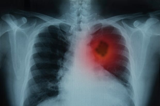 Ποια είναι τα συμπτώματα του καρκίνου του πνεύμονα; Υπάρχει θεραπεία για καρκίνο του πνεύμονα; Για να αποφύγετε τον καρκίνο των