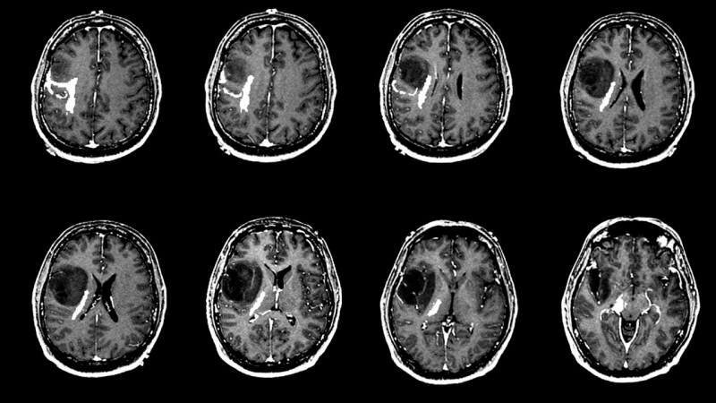 Τι προκαλεί έναν όγκο στον εγκέφαλο; Ποια είναι τα συμπτώματα του όγκου του εγκεφάλου; Είναι δύσκολη η θεραπεία του όγκου του εγκεφάλου;