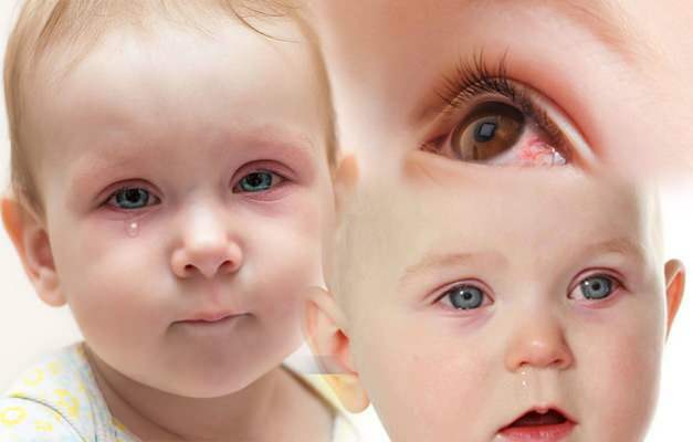 προκαλεί αιμορραγία των ματιών στα μωρά