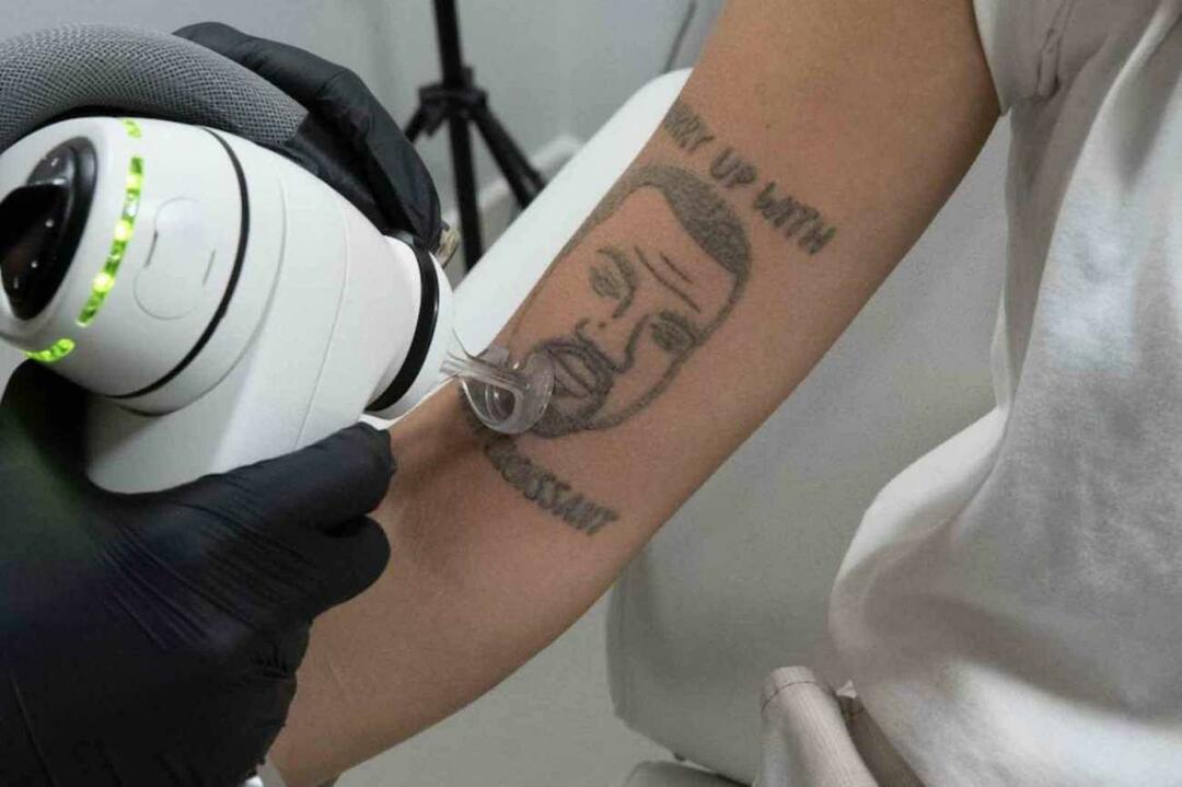 Το τατουάζ του Kanye West θα αφαιρεθεί δωρεάν στο Λονδίνο 