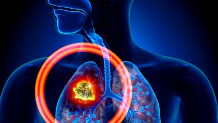 Ποια είναι τα συμπτώματα του καρκίνου του πνεύμονα; Υπάρχει θεραπεία για καρκίνο του πνεύμονα; Για να αποφύγετε τον καρκίνο των