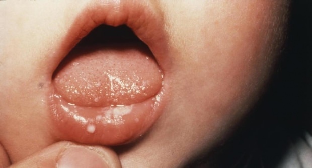 Πώς είναι οι πληγές στο στόμα στα μωρά