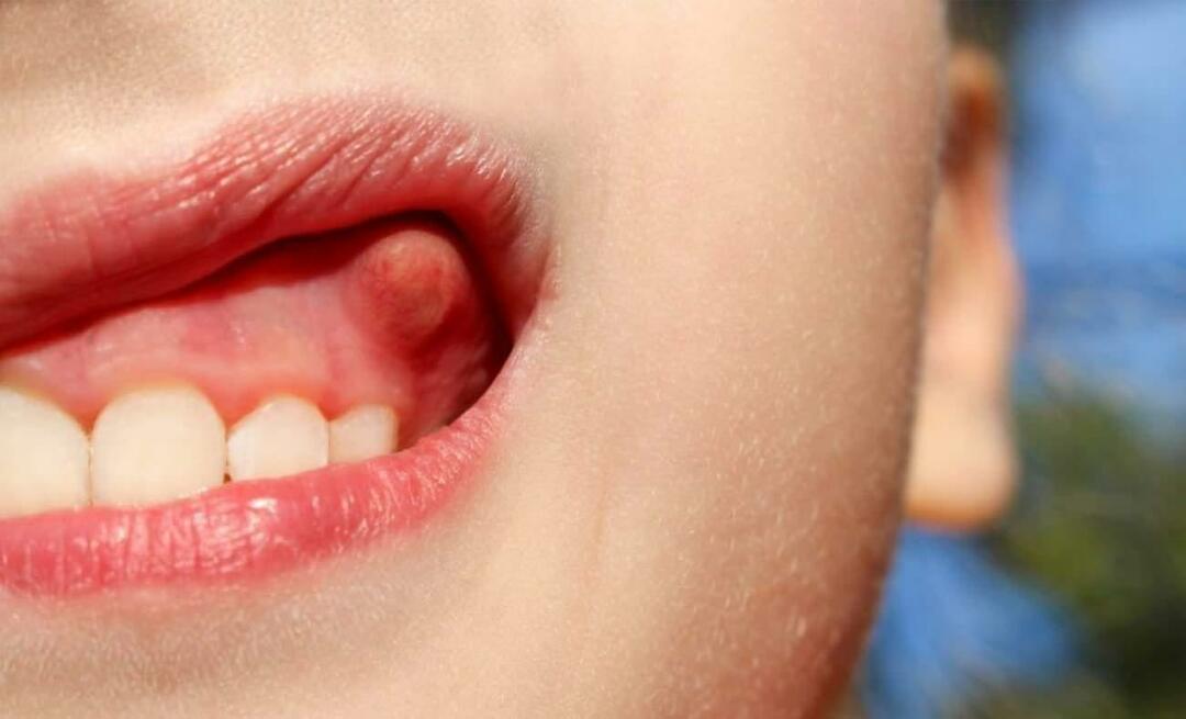Γιατί το απόστημα των δοντιών και ποια είναι τα συμπτώματα; Οδοντικό απόστημα, πώς αντιμετωπίζεται;