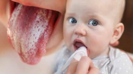 Συμπτώματα και θεραπεία της τσίχλας στα μωρά! Πώς είναι η τσίχλα στα μωρά;