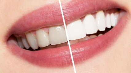 Ποιες είναι οι συστάσεις για τα λευκά δόντια; Θεραπεία λεύκανσης δοντιών φυσικά στο σπίτι ...