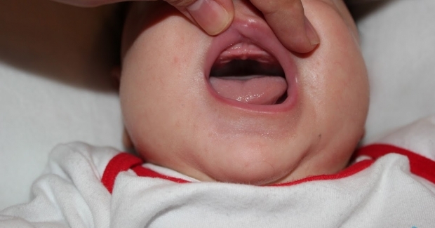 Τι είναι η σταγόνα ουρανίου στα μωρά, γιατί; Συμπτώματα και θεραπεία ...