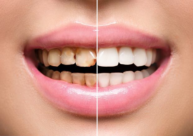Ως αποτέλεσμα της ανθυγιεινής διατροφής, εμφανίζονται τόσο ο αποχρωματισμός των δοντιών όσο και η απώλεια δοντιών