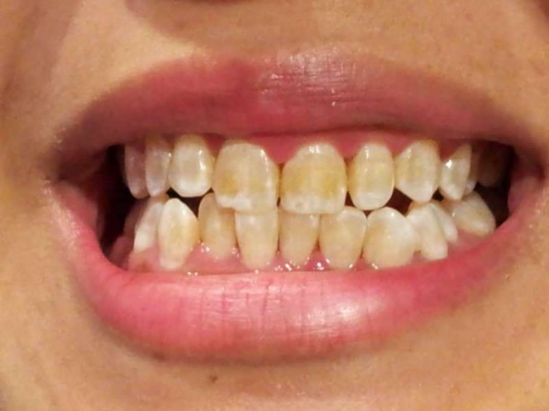 εικόνα δοντιού ενός ατόμου του οποίου τα δόντια αρχίζουν να σκουραίνουν
