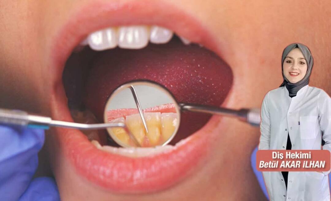 Τι πρέπει να γίνει για να αποφευχθεί η πέτρα; Ποια είναι τα οφέλη της οδοντικής απολέπισης;